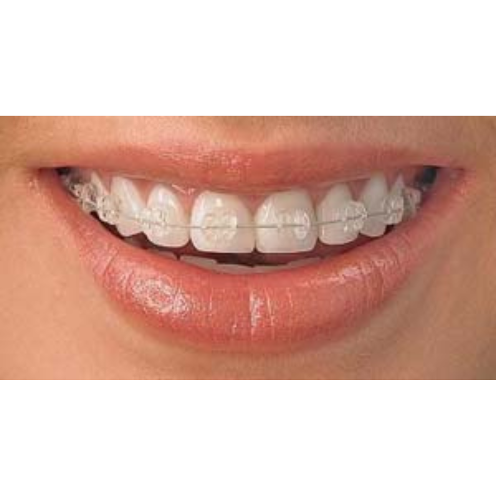 Brackets Zafiro Radiance American Orthodontics